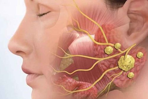 cirurgia-das-glandulas-salivares